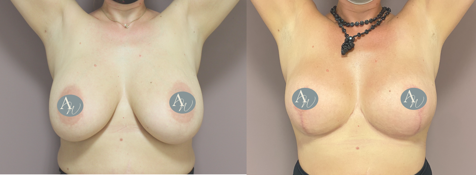 Avant/Après lifting seins et réduction mammaire